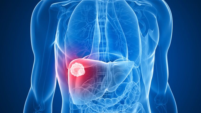آیا کبد چرب عامل سرطان است؟