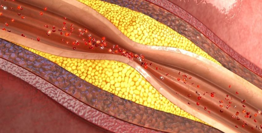 تاثیر کم خوابی بر ابتلا به مشکلات عروق خونی