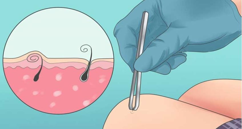 علت زیر پوستی شدن مو و روش درمان و جلوگیری از ایجاد آن