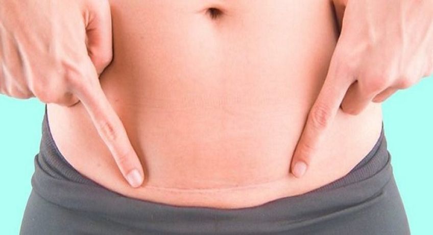 جراحی زیبایی شکم و خطرات ناشی از آن