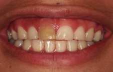 اشتباهات رایج روزانه که منجر به پوسیدگی دندان می شوند