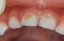 دلیل پوسیدگی زود هنگام دندان کودکان