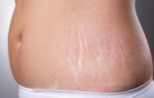 درمان ترک های پوستی با روش های خانگی