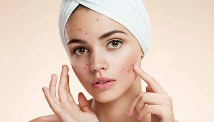 راهکار هایی برای پیشگیری از جوش زدن صورت