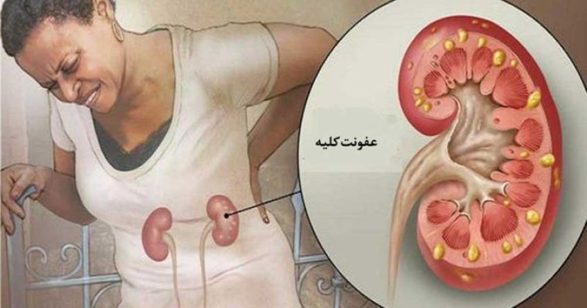 هرآنچه که در مورد عفونت کلیه باید بدانیم