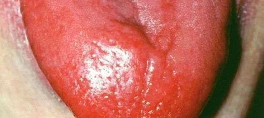 عوارض التهاب زبان یا گلوسیت چیست