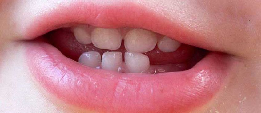 دندان نوزاد چه زمانی رشد می کند و علائم آن چیست