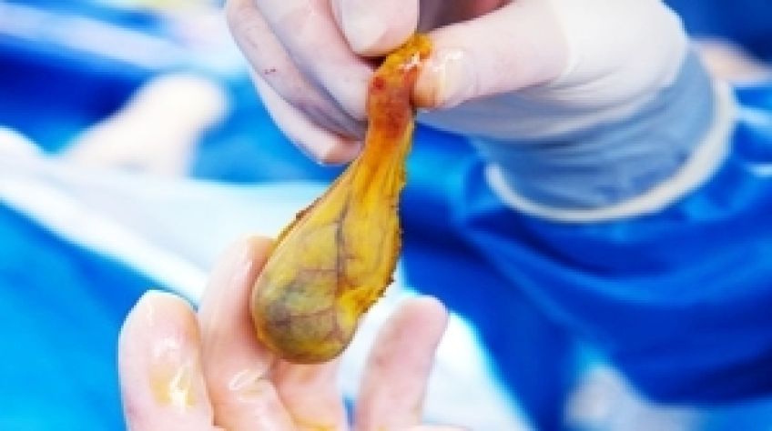 بعد از عمل جراحی صفرا یا کله سیستکتومی  چه غذا هایی را بخوریم