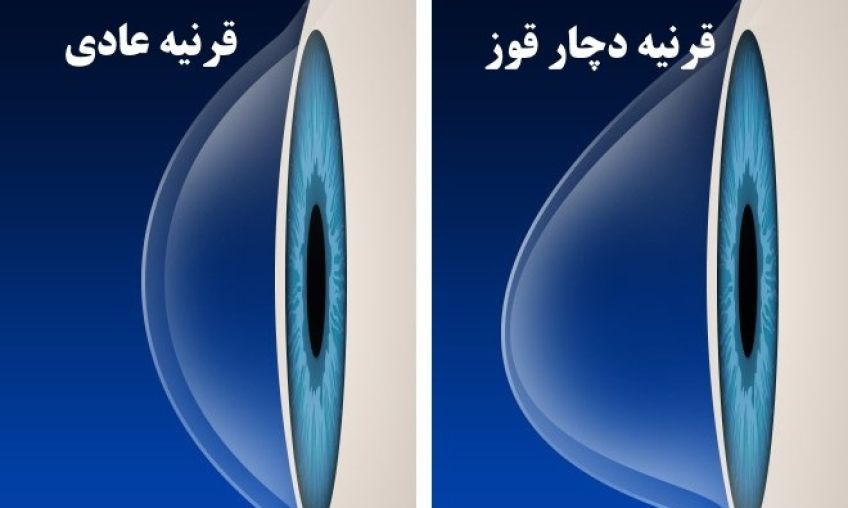 علل قوز قرنیه و راه های درمان آن