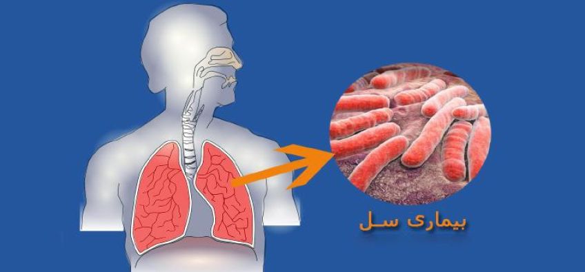 بیماری سل و علائم آن