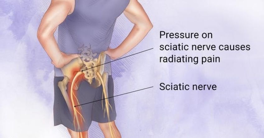 تشخیص سیاتیک و درمان آن