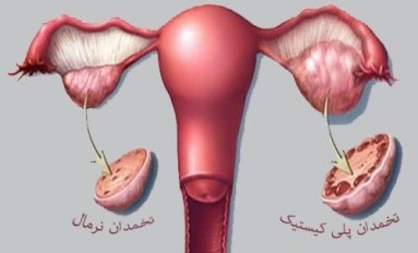 علت تنبلی تخمدان و راه های درمان آن