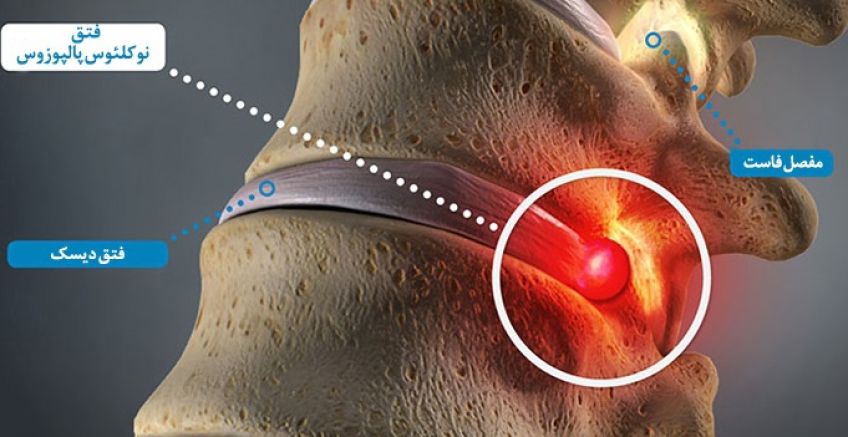 دیسک کمر و درمان آن