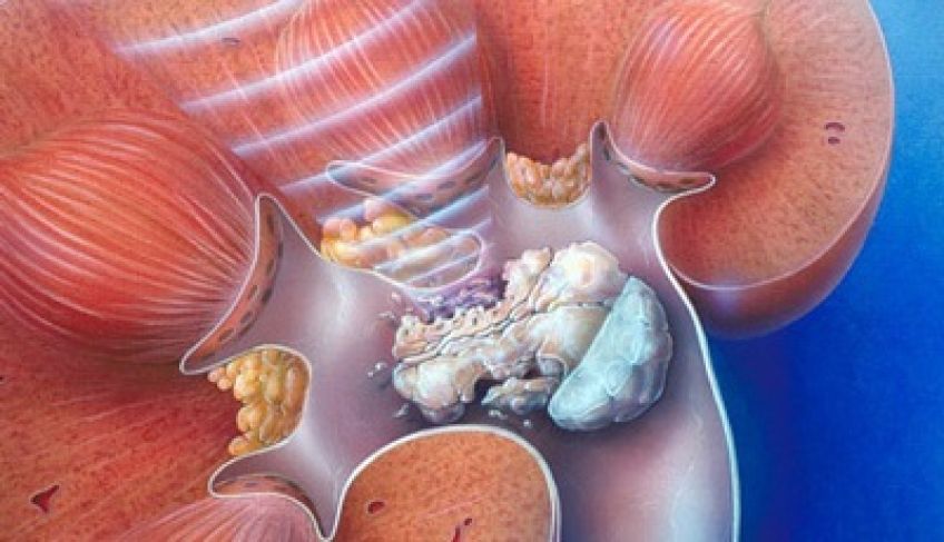 دفع سنگ کلیه به روش طبیعی