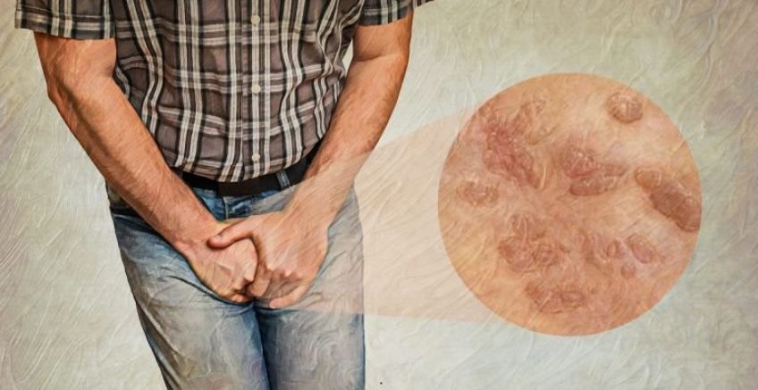 علت به وجود آمدن زگیل تناسلی و درمان خانگی آن