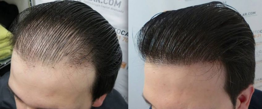 برای کاشت و پیوند مو چه سنی مناسب است