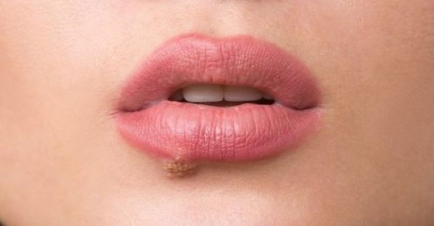 چه زمانی بیشتر تبخال می زنیم