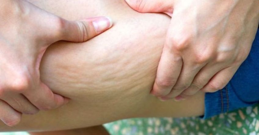 رژیم غذایی و عادات غذایی مفید برای درمان و از بین بردن سلولیت