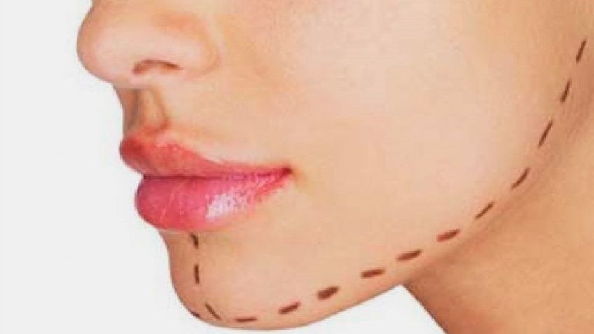 راهنمایی کامل درباره ایمپلنت چانه