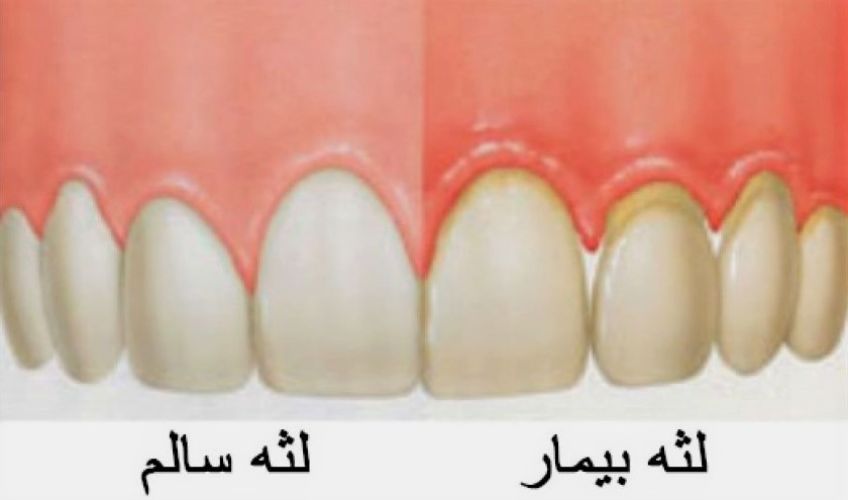 بیماری لثه و عوارض جانبی آن