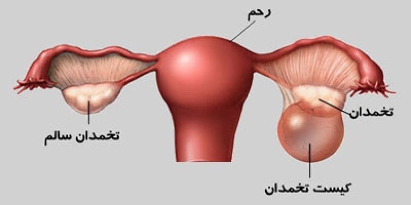 در مورد تنبلی تخمدان بدانیم