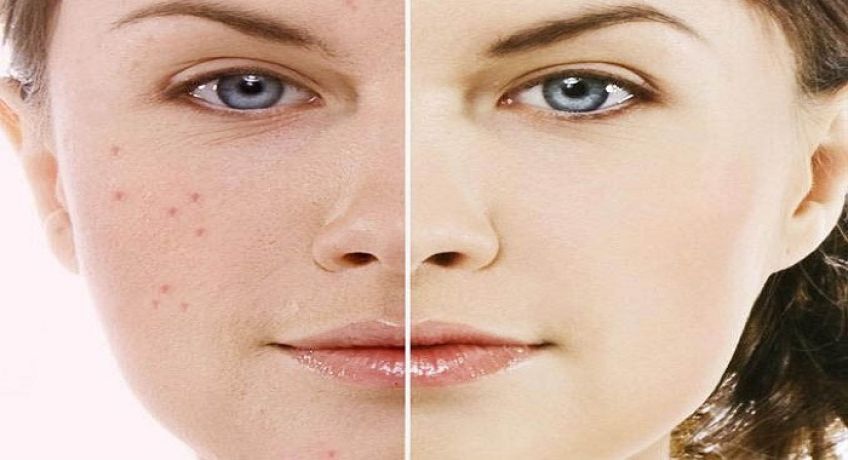 طریقه آرایش صورت های جوش دار