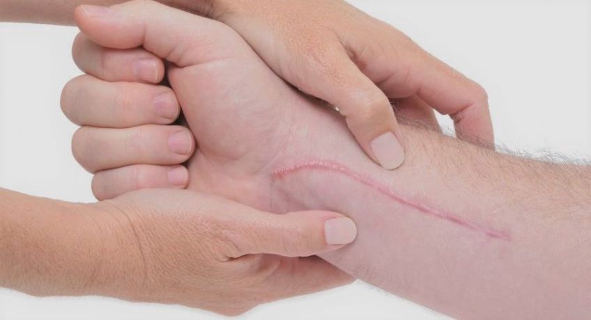 چندین راهکار اساسی برای درمان جای بخیه با طب سنتی