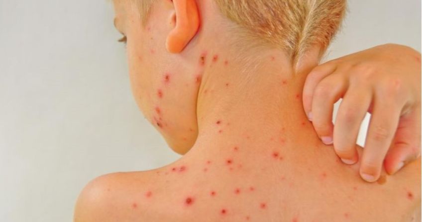 بیماری سندروم ری چیست و راه های درمان آن چیست