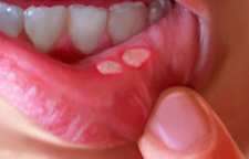 آفت دهان  و راه های درمان آن چیست؟