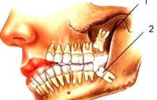 آیا دندان عقل را بکشیم یا خیر؟