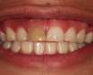 اشتباهات رایج روزانه که منجر به پوسیدگی دندان می شوند