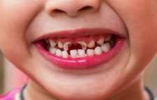 انواع لکه دندانی کودکان و درمان آن