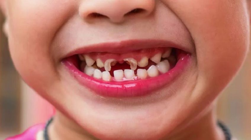 انواع لکه دندانی کودکان و درمان آن