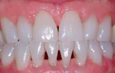 تحلیل لثه و راه های درمان آن