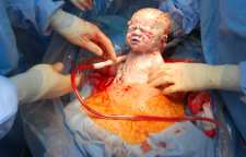 سزارین چه موقع جایگزین زایمان طبیعی می شود؟