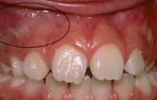 رابطه گلودرد با عفونت دندان