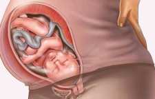 علت پارگی دهانه رحم در زایمان طبیعی