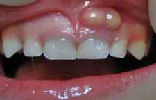 آبسه دندان و داروهایی که در این مواقع استفاده نماییم