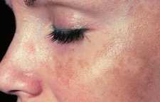 بررسی شباهت و تفاوت بیماری های پوستی پسوریازیس و لوپوس