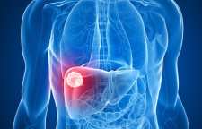 آیا کبد چرب عامل سرطان است؟