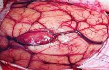 تومور مغزی و علائم شایع این بیماری