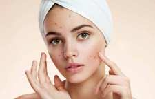 راهکار هایی برای پیشگیری از جوش زدن صورت