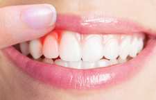 ورم لثه را چگونه تشخیص بدهیم و راه های درمان آن