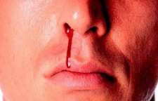 دلیل خون دماغ شدن چیست