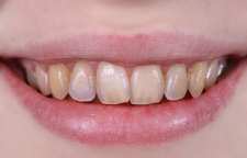 تغییر رنگ دندان و  روش های پیشگیری از آن