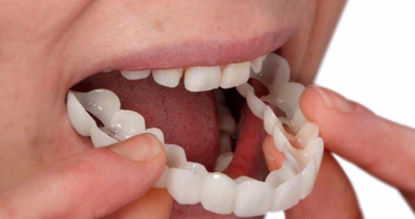 لامینت یا ونیر دندان چیست؟