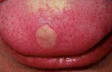 آیا زخم روی زبان ممکن است نشانه سرطان باشد؟
