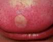 آیا زخم روی زبان ممکن است نشانه سرطان باشد؟