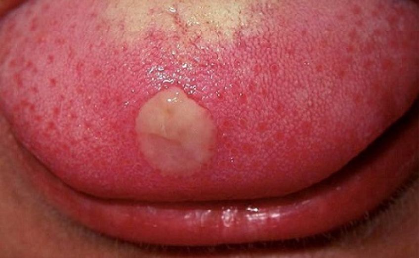 آیا زخم روی زبان ممکن است نشانه سرطان باشد؟