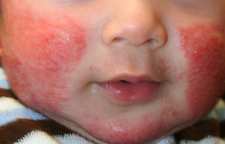 علائم بیماری راش